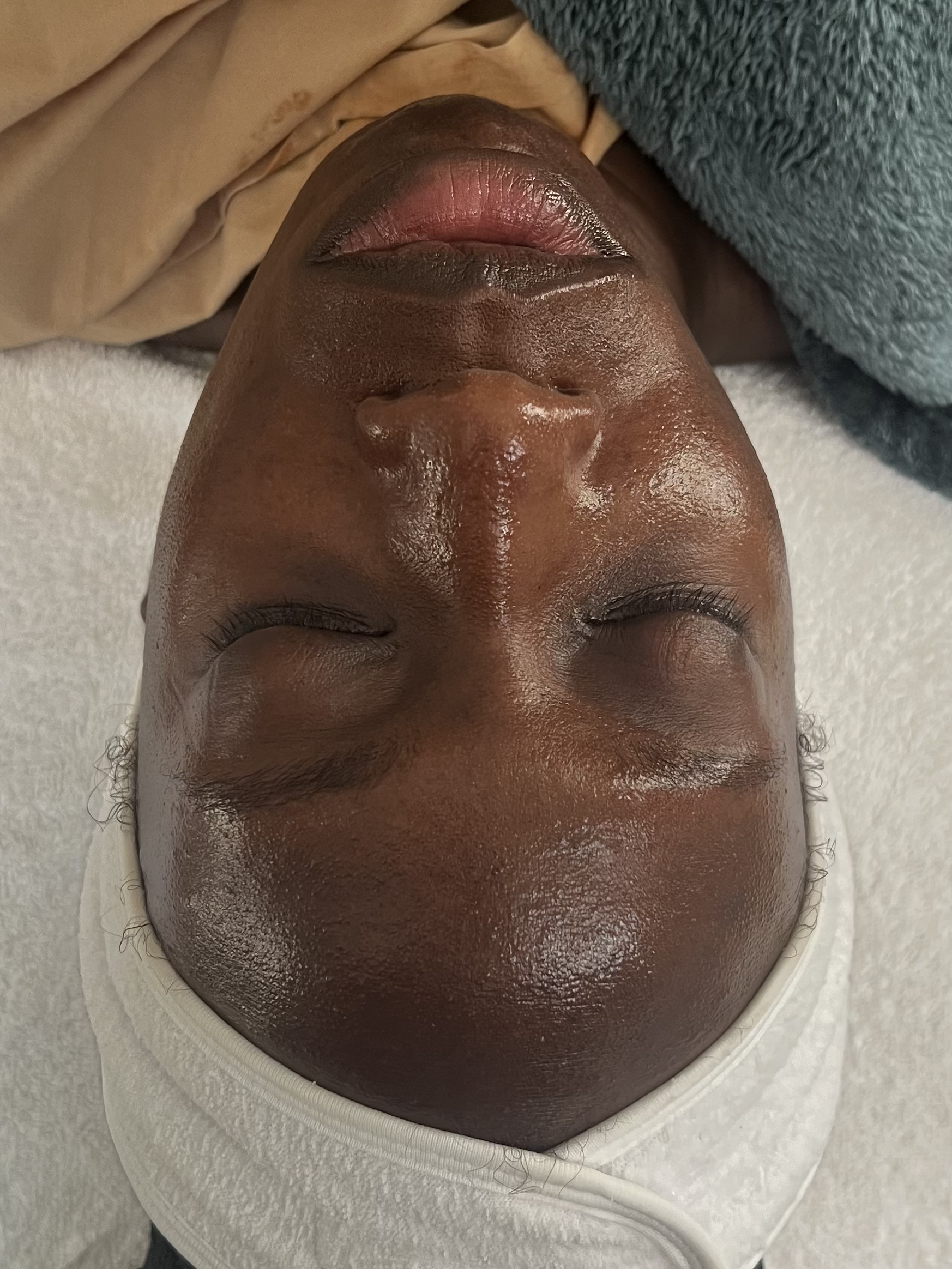 Client skin after corrective facial microdermabrasion Manchester CT
